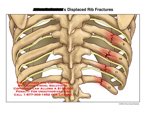 Diseases of the musculoskeletal system and connective tissue. . Icd 10 code for fractured ribs